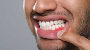 diferenca-entre-periodontite-e-gengivite_mangolin odontologia