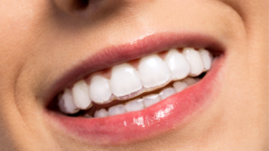 alinhadores invisalign mangolin odontologia