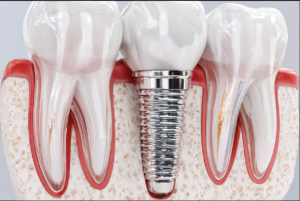 protese-dentaria-digital-mangolin-odontologia