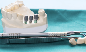 implante-dentario-como-funciona