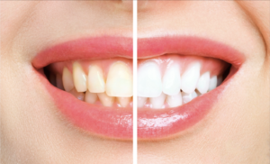 clareamento-dental-vai-alem-da-aparencia